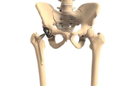 Revision Hip Replacement